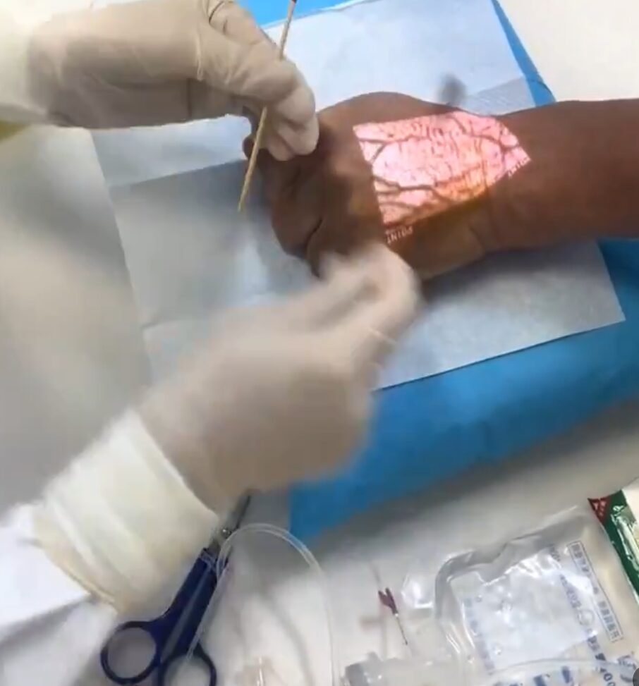 Vein Finder:Teknologi Perubatan Memudahkan Petugas Kesihatan
